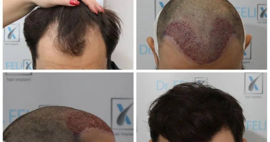 Imagine pentru articolul: Implant sau transplant de păr prin tehnica FUE avansat, vezi detalii despre Dr. Felix Hair Implant
