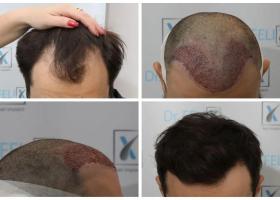 Imagine: Implant sau transplant de păr prin tehnica FUE avansat, vezi detalii despre...
